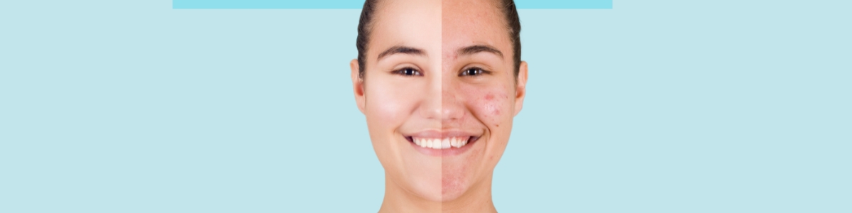 Diversas funciones del ácido azelaico en productos cosméticos.